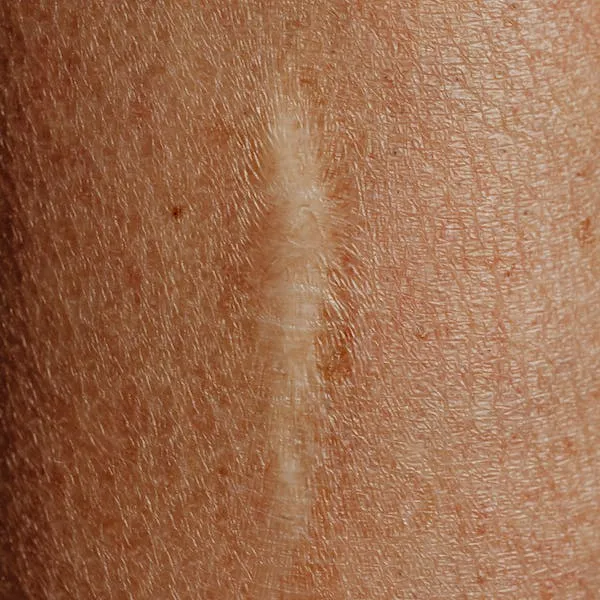 cicatriz